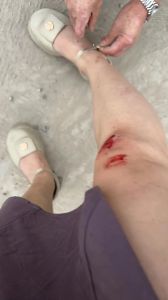 骑小电驴摔伤的图片_电驴摔倒血流满地，骑行安全要牢记！